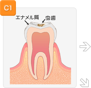 歯の表面だけが虫歯の場合