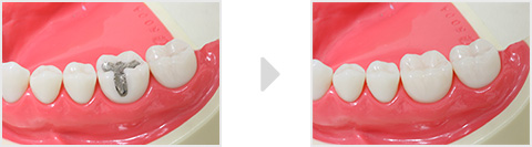 奥の銀歯でもかなり目立ちます。