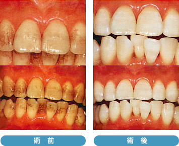 オフィスホワイトニング