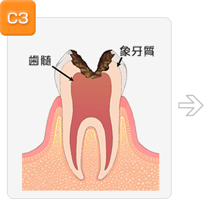 虫歯が神経まで到達している場合