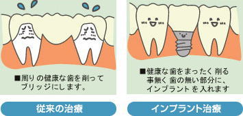 歯が1本抜けた場合